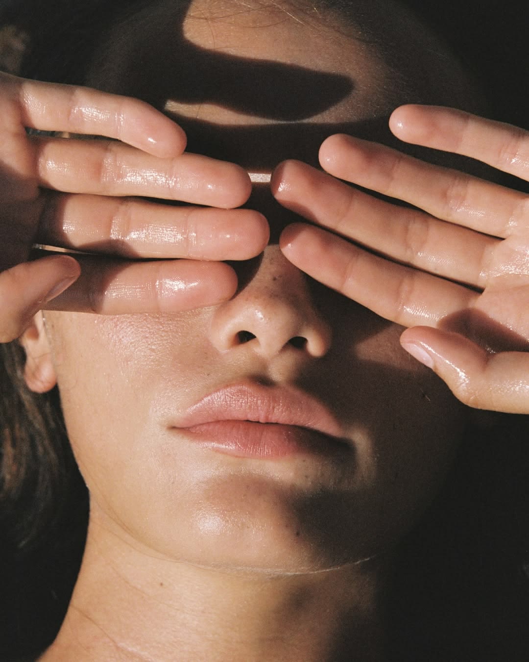 Why Hyperpigmentation Gets Worse in Summer